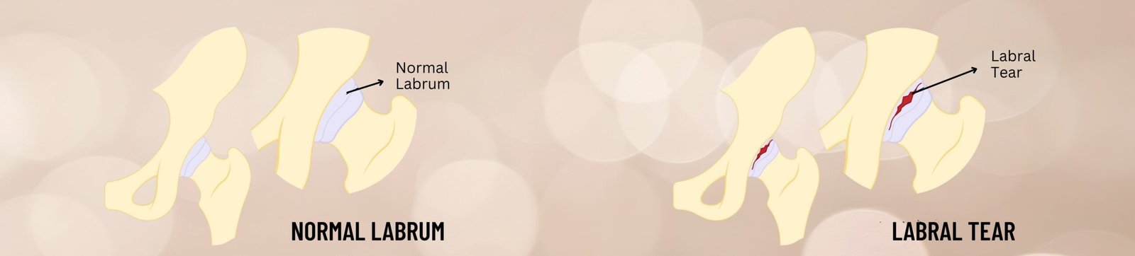 Fast relief from Hip Labral Tear in Nagpur - Dr. Nawaid Ahmed - Dr ...