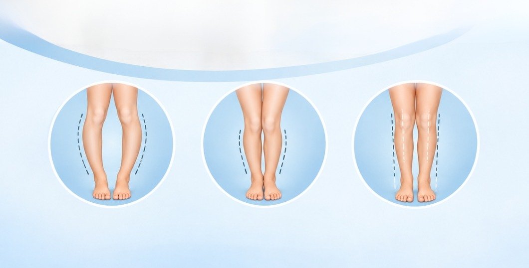 Bow Legs vs Normal Legs