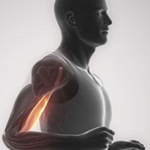 biceps-tendon-injuries-treatment-in-nagpur1